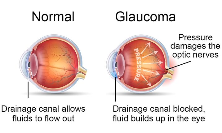 Glaucoma Treatment – Georgina Eye Clinic