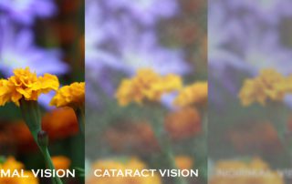 15 THINGS YOU NEED TO KNOW ABOUT CATARACT SURGERY